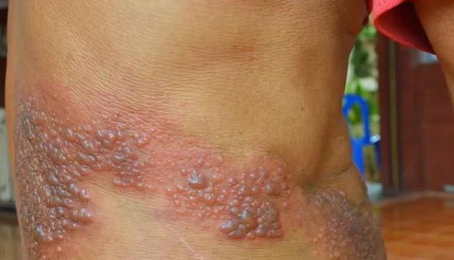 飞蛇疱疹与白酒:真相揭秘及预防方法-香烟网